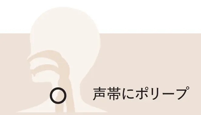 鼻・喉からくる不調の原因は？「副鼻腔炎、後鼻漏」「声帯ポリープ」「扁桃炎」について医師が解説_1_7