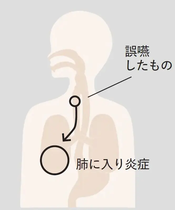 誤嚥性肺炎