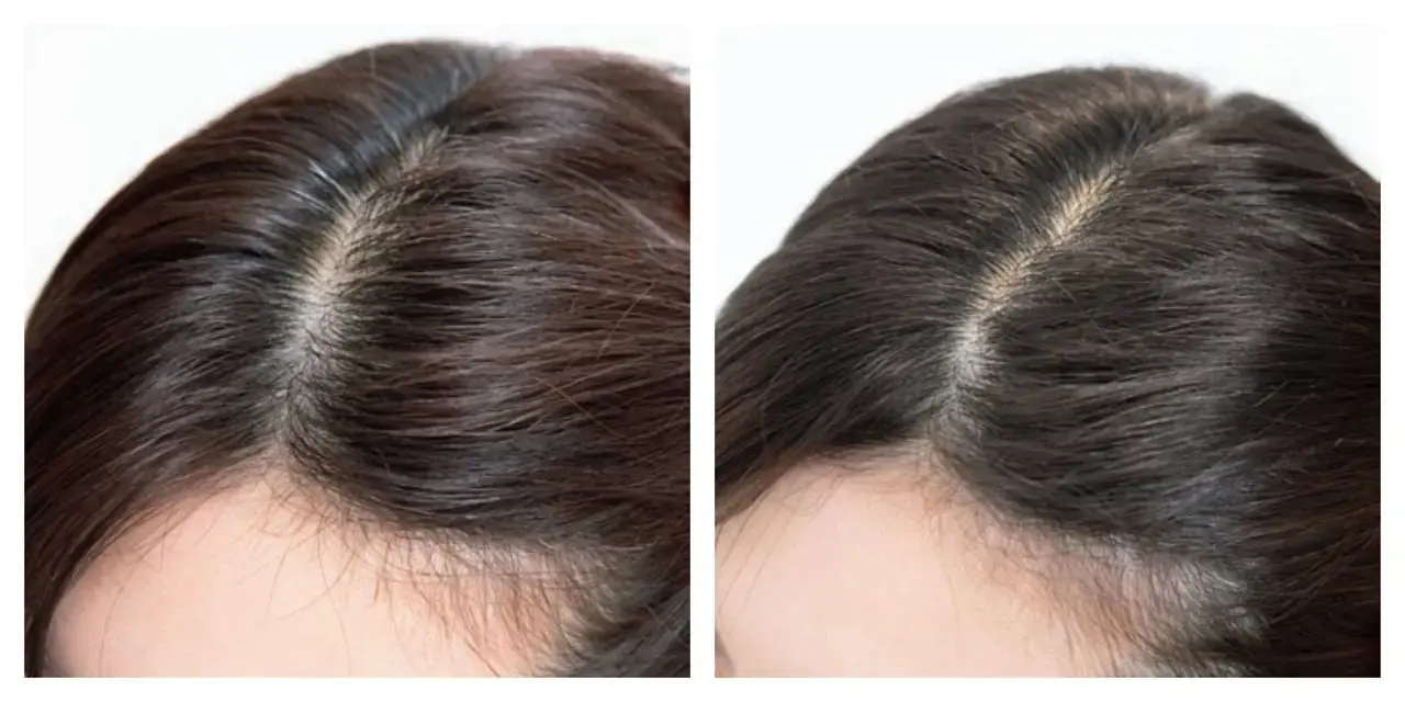 『ヒト幹細胞上清液エクソソーム頭皮スパ』の感想は？