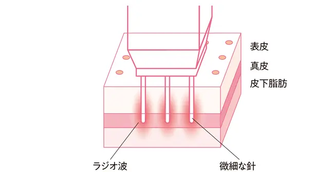 ポテンツァ(ニードルRF)