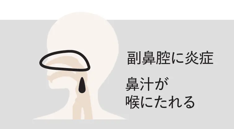 鼻・喉からくる不調の原因は？「副鼻腔炎、後鼻漏」「声帯ポリープ」「扁桃炎」について医師が解説_1_3