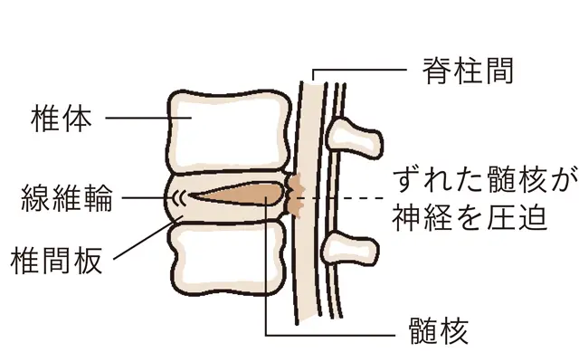 ぎっくり腰のメカニズム　髄核が後ろにずれて線維輪に亀裂が入る