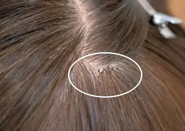 装着完了。近くで見ると毛穴が黒く大きく見えるが、遠目にはまったく判別不能。自毛に合わせてカットして終了。