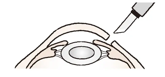 ❶角膜を切開し、白くにごった水晶体の前嚢（水晶体を包む薄い膜の前部分）を切り取る。