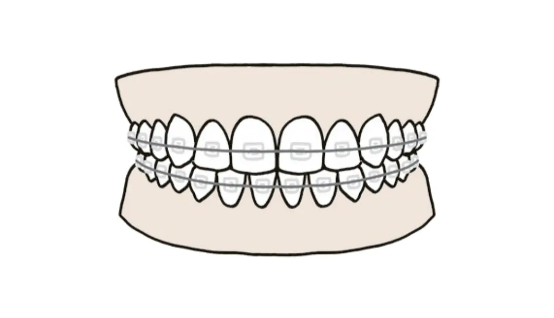 50代　歯並び　対策　ワイヤー矯正　病院　歯列矯正　表側矯正　イメージイラスト