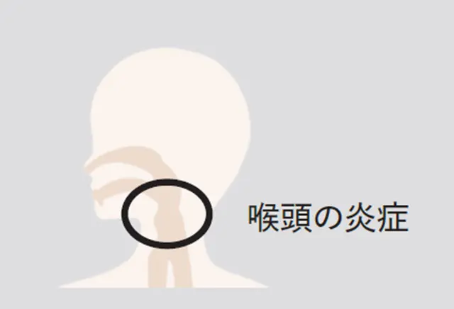 鼻・喉からくる不調の原因は？「上咽頭炎」「喉頭炎」について医師が解説_1_5