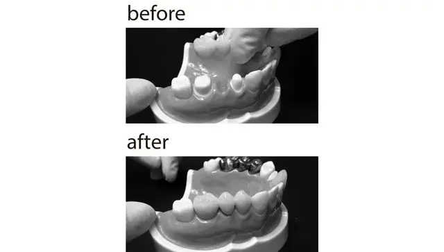 歯が欠損した部分に、両サイドに支えられるように3連のブリッジを架け、擬似歯を作る