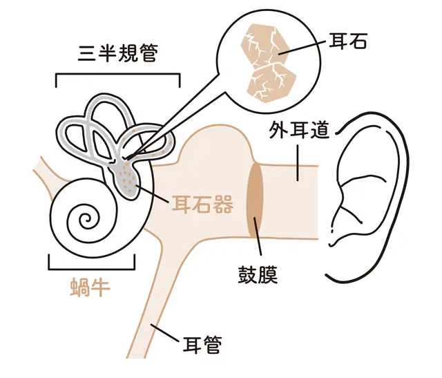 【 内耳の「耳石」が動いてめまいが起きる 】