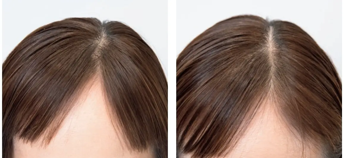 AFLOAT RUVUAの『ヘアループ』を実際に装着したビフォーアフター　分け目の写真