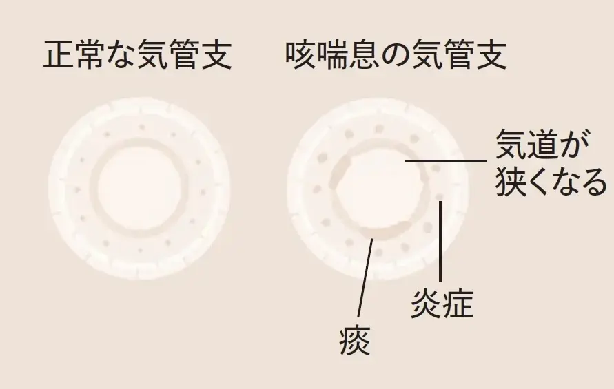 咳喘息