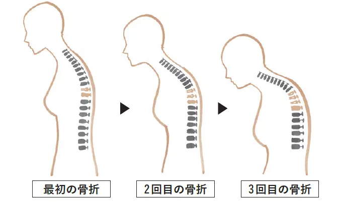 〝ドミノ骨折〞を引き起こすことも
