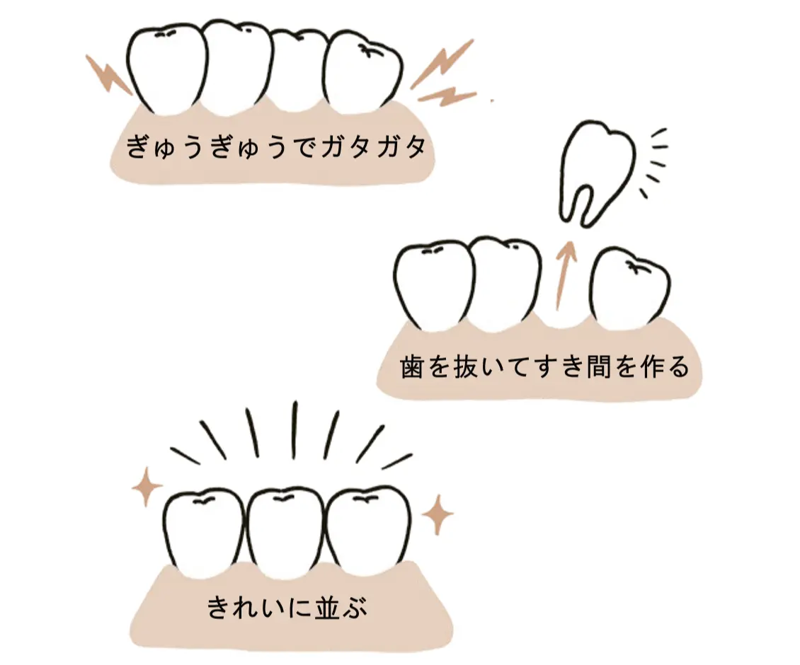 50代　歯並び　病院　歯列矯正　イメージイラスト