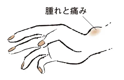 2. 親指側の手首が痛む “ドケルバン病”【50代のお悩み・更年期の手指問題】_1_2