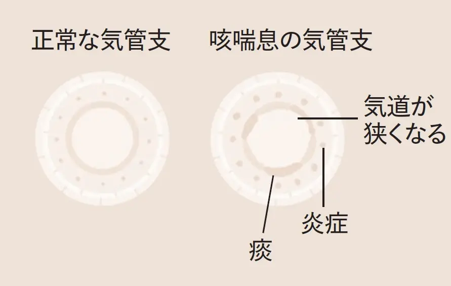 呼吸器からくる不調の原因は？「咳喘息」「誤嚥性肺炎」について医師が解説_1_3