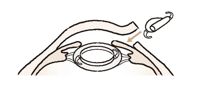 ❸残した後嚢の中に眼内レンズを挿入する。短時間で終わる日帰り手術が中心で、術後の翌日から疲れない程度に目を使える。