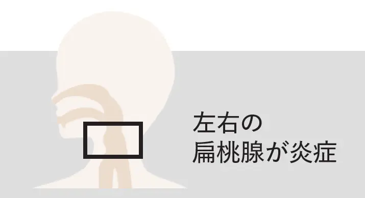 鼻・喉からくる不調の原因は？「副鼻腔炎、後鼻漏」「声帯ポリープ」「扁桃炎」について医師が解説_1_9