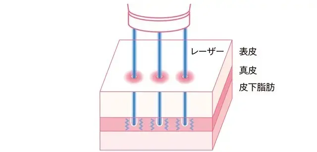 老け見えの原因は「たるみ毛穴」!? 50代が損する「たるみ毛穴」撃退方法まとめ_1_48