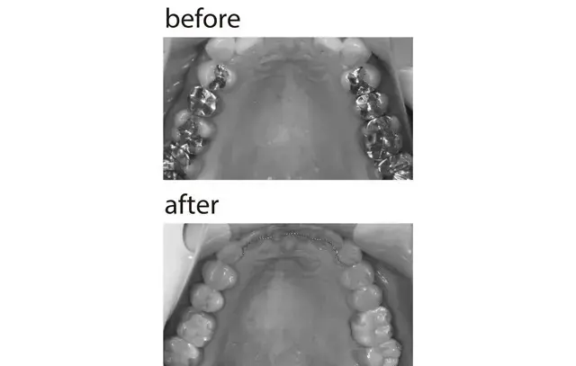 奥歯4本ずつの銀歯をセラミックに変え、前歯には裏側ワイヤー矯正も。人に見せたくなる仕上がりに