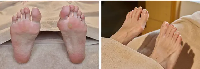 施術前