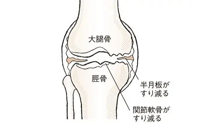 変形性膝関節症の関節