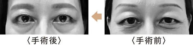 眼瞼余剰皮膚切除術の症例
