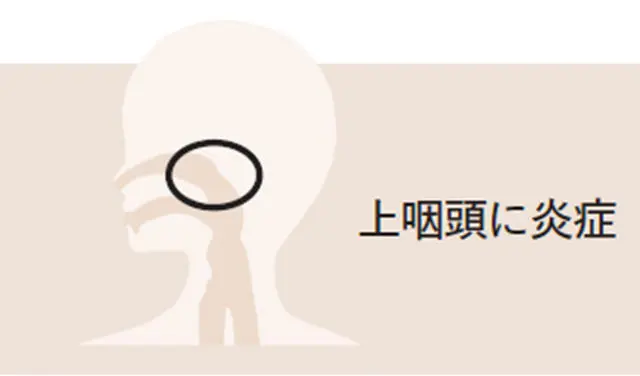 鼻・喉からくる不調の原因は？「上咽頭炎」「喉頭炎」について医師が解説_1_3