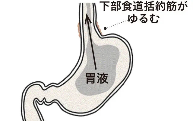 逆流性食道炎の胃