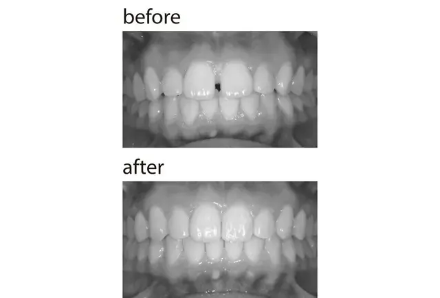 すき間が目立つ上の前歯2本にダイレクトボンディングを。隣の歯とも自然になじんでいる