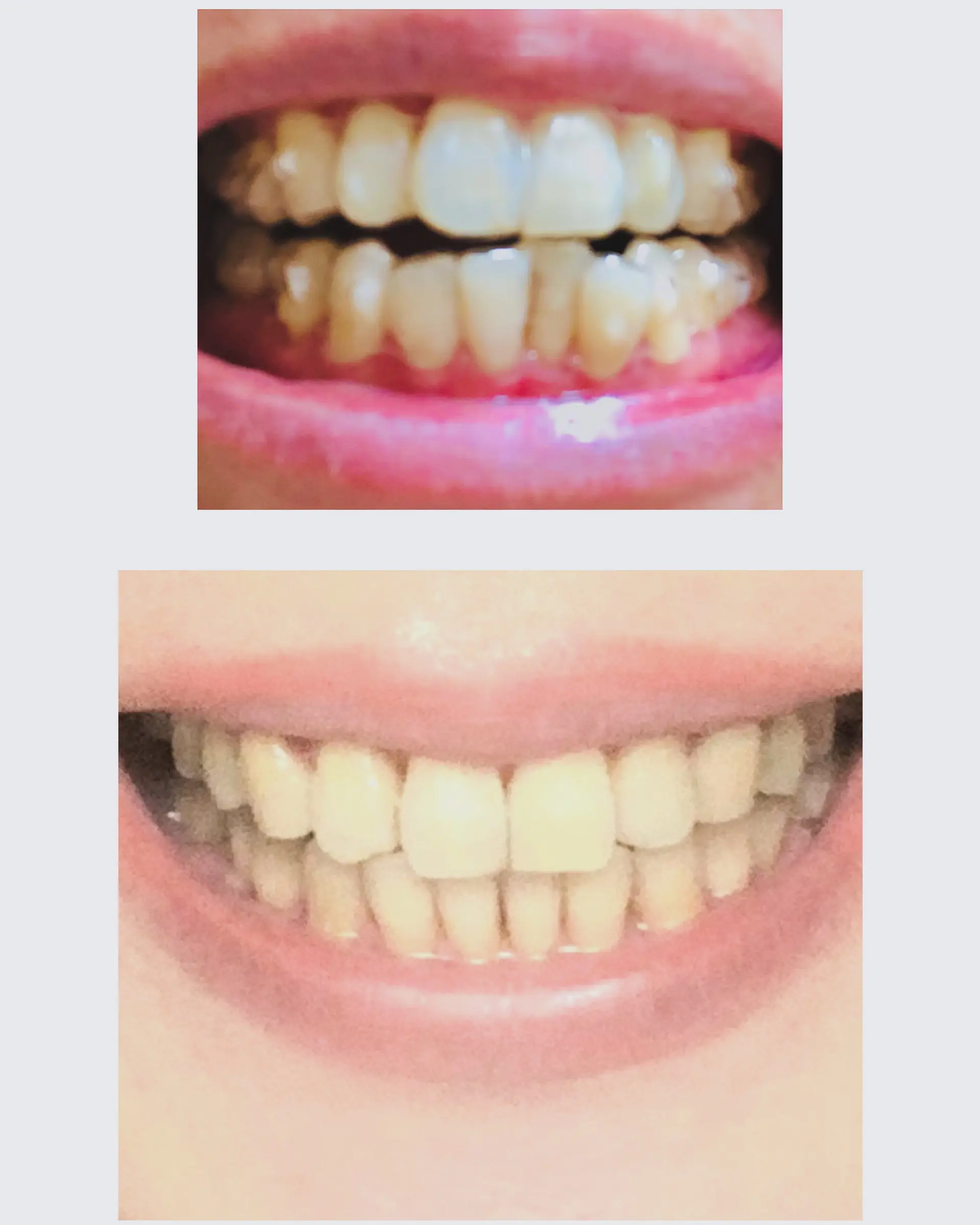 歯磨き粉でホワイトニング✨_1_1