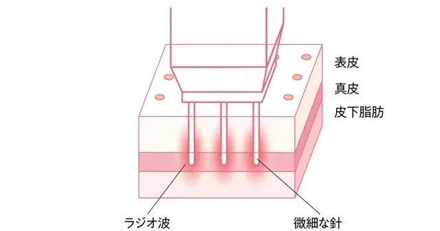 老け見えの原因は「たるみ毛穴」!? 50代が損する「たるみ毛穴」撃退方法まとめ_1_47