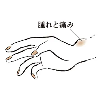 2. 親指側の手首が痛む “ドケルバン病”【50代のお悩み・更年期の手指問題】
