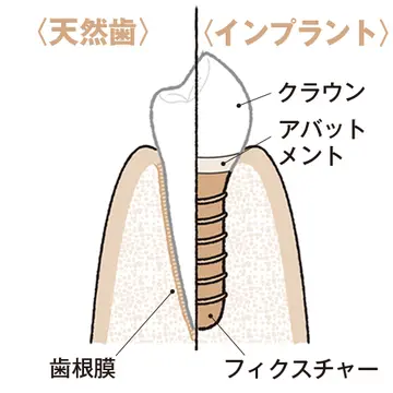 本当の歯のように噛めて顎骨も維持できるのが利点