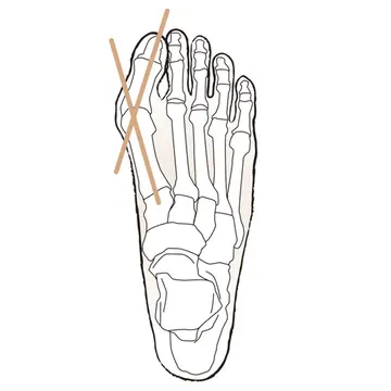 【50代、足と脚の違和感】「外反母趾」はどんな症状？原因と対策は？